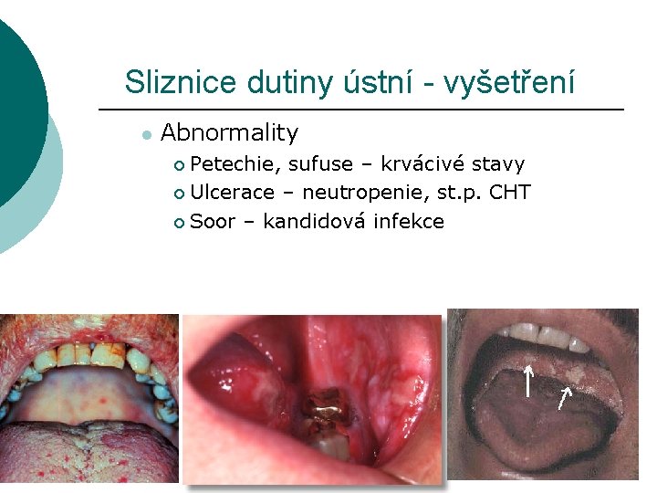 Sliznice dutiny ústní - vyšetření l Abnormality Petechie, sufuse – krvácivé stavy ¡ Ulcerace