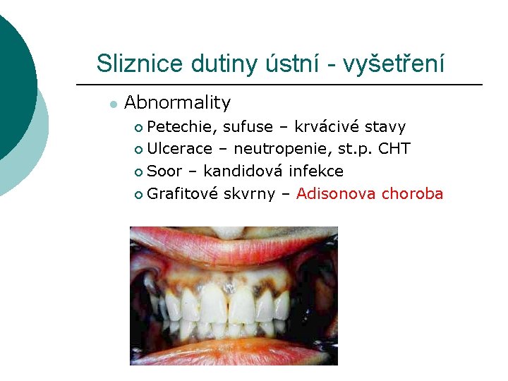 Sliznice dutiny ústní - vyšetření l Abnormality Petechie, sufuse – krvácivé stavy ¡ Ulcerace