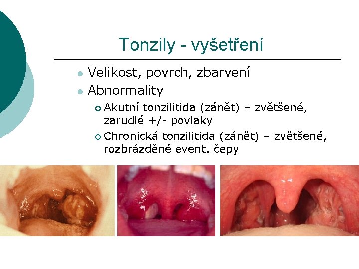 Tonzily - vyšetření l l Velikost, povrch, zbarvení Abnormality Akutní tonzilitida (zánět) – zvětšené,