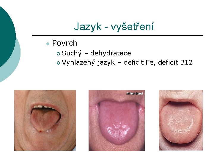 Jazyk - vyšetření l Povrch Suchý – dehydratace ¡ Vyhlazený jazyk – deficit Fe,