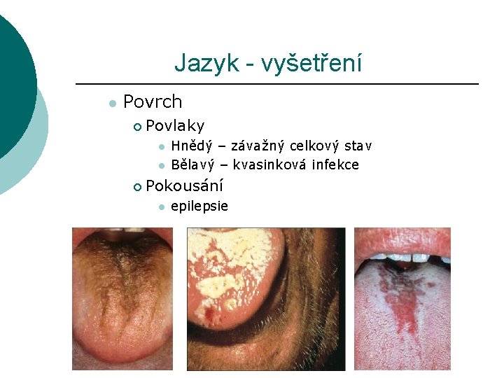 Jazyk - vyšetření l Povrch ¡ Povlaky l l ¡ Hnědý – závažný celkový