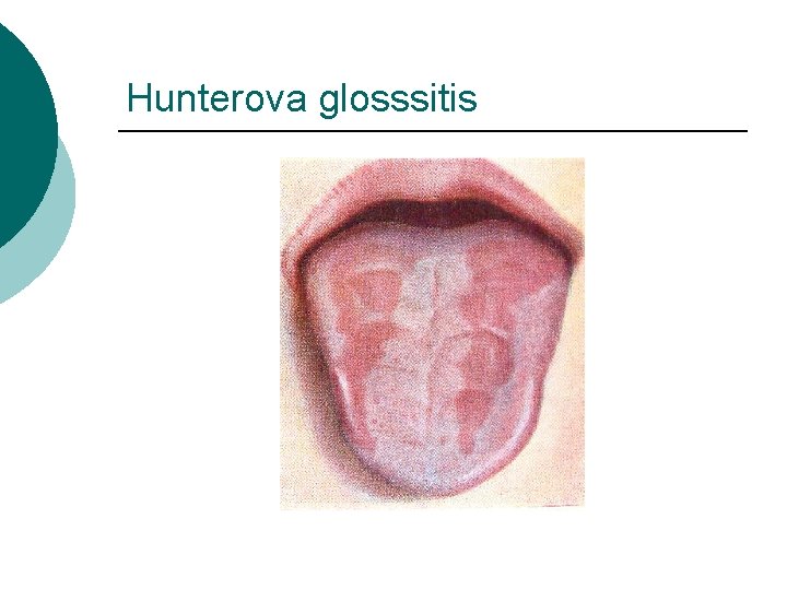Hunterova glosssitis 
