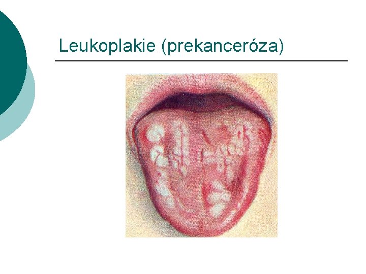 Leukoplakie (prekanceróza) 