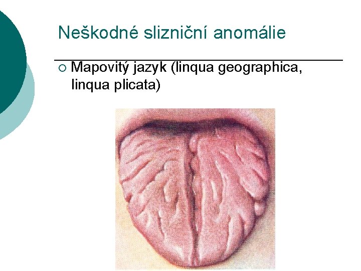 Neškodné slizniční anomálie ¡ Mapovitý jazyk (linqua geographica, linqua plicata) 