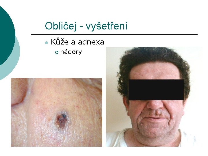 Obličej - vyšetření l Kůže a adnexa ¡ nádory 