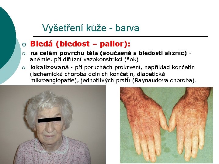 Vyšetření kůže - barva ¡ ¡ ¡ Bledá (bledost – pallor): na celém povrchu