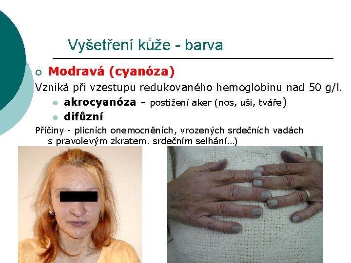 Vyšetření kůže - barva ¡ Modravá (cyanóza) Vzniká při vzestupu redukovaného hemoglobinu nad 50