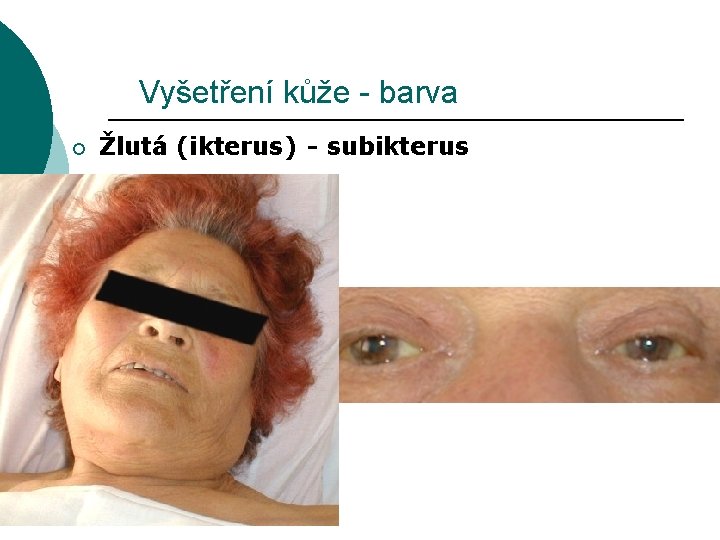 Vyšetření kůže - barva ¡ Žlutá (ikterus) - subikterus 