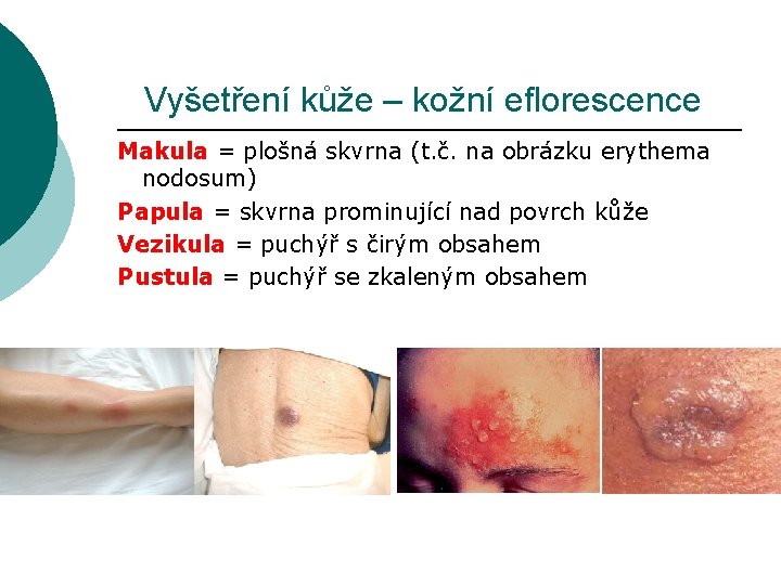 Vyšetření kůže – kožní eflorescence Makula = plošná skvrna (t. č. na obrázku erythema