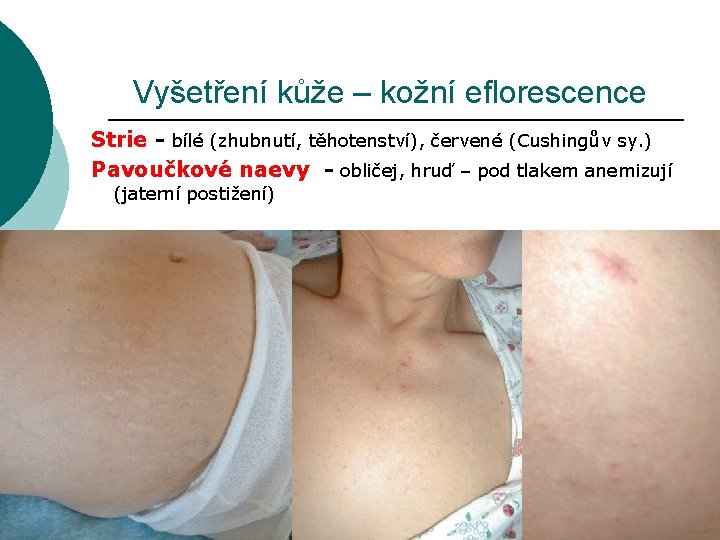 Vyšetření kůže – kožní eflorescence Strie - bílé (zhubnutí, těhotenství), červené (Cushingův sy. )