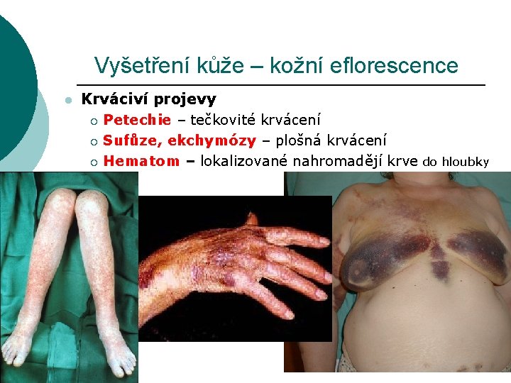 Vyšetření kůže – kožní eflorescence l Krváciví projevy ¡ Petechie – tečkovité krvácení ¡