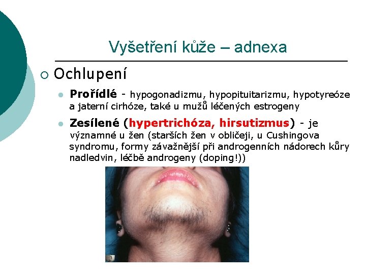 Vyšetření kůže – adnexa ¡ Ochlupení l Prořídlé - hypogonadizmu, hypopituitarizmu, hypotyreóze a jaterní