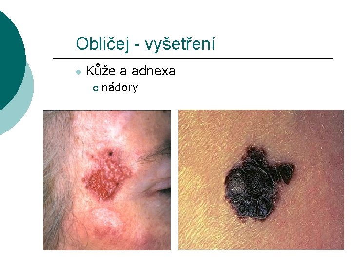 Obličej - vyšetření l Kůže a adnexa ¡ nádory 