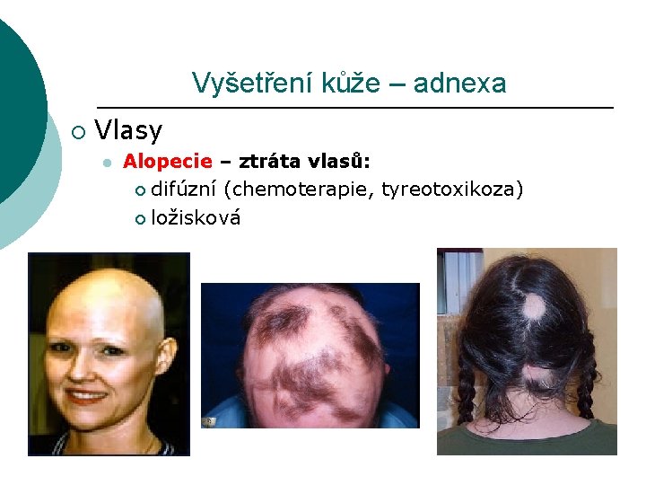 Vyšetření kůže – adnexa ¡ Vlasy l Alopecie – ztráta vlasů: ¡ difúzní (chemoterapie,