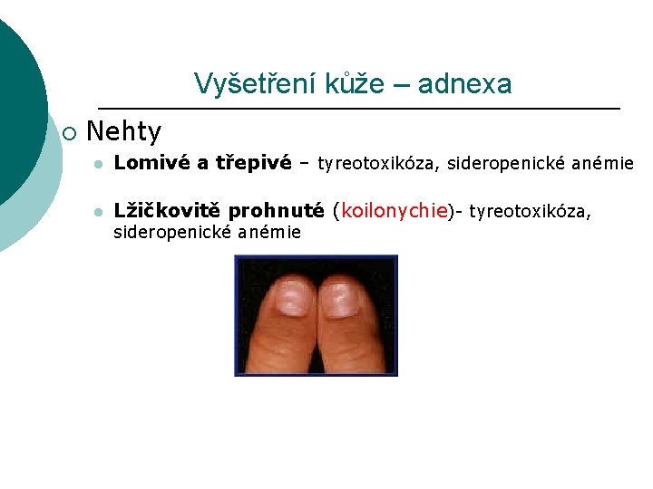 Vyšetření kůže – adnexa ¡ Nehty l Lomivé a třepivé – tyreotoxikóza, sideropenické anémie