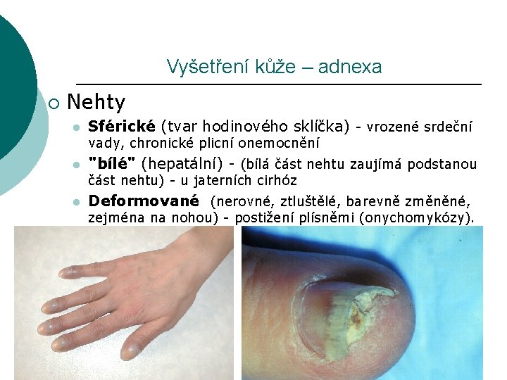 Vyšetření kůže – adnexa ¡ Nehty l Sférické (tvar hodinového sklíčka) - vrozené srdeční