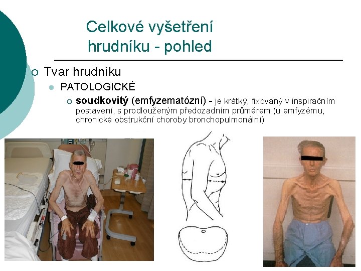 Celkové vyšetření hrudníku - pohled ¡ Tvar hrudníku l PATOLOGICKÉ ¡ soudkovitý (emfyzematózní) -