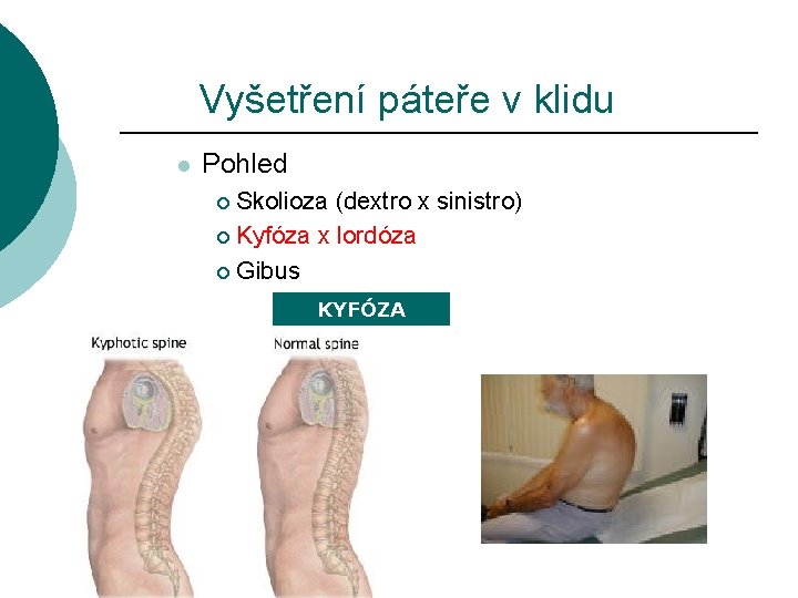 Vyšetření páteře v klidu l Pohled Skolioza (dextro x sinistro) ¡ Kyfóza x lordóza