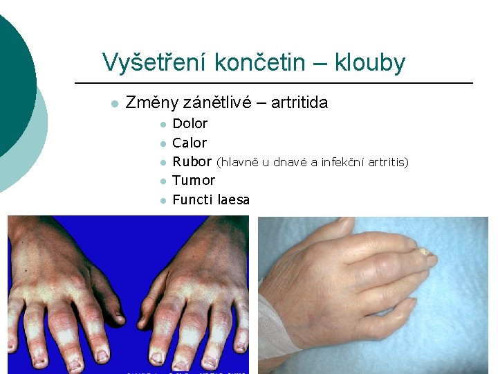 Vyšetření končetin – klouby l Změny zánětlivé – artritida l l l Dolor Calor