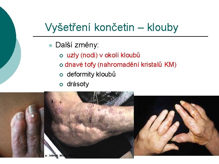 Vyšetření končetin – klouby l Další změny: uzly (nodi) v okolí kloubů ¡ dnavé