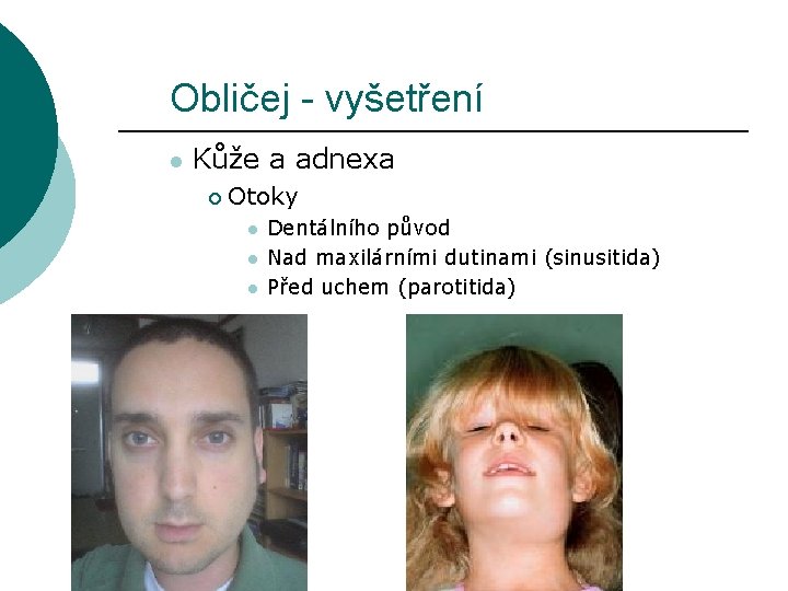 Obličej - vyšetření l Kůže a adnexa ¡ Otoky l l l Dentálního původ