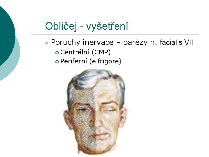 Obličej - vyšetření l Poruchy inervace – parézy n. facialis VII Centrální (CMP) ¡