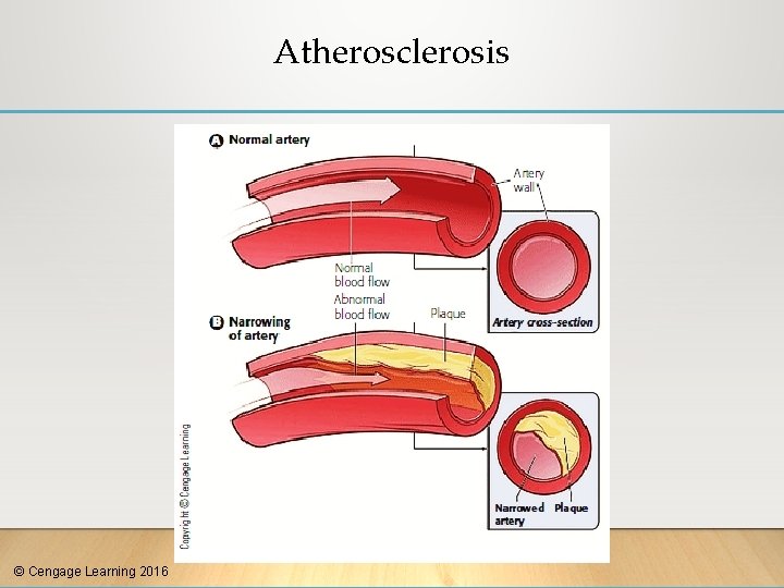 Atherosclerosis © Cengage Learning 2016 
