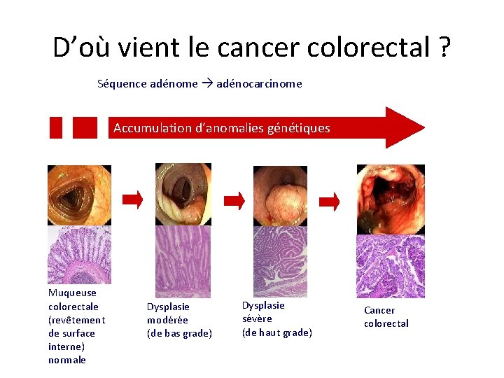 D’où vient le cancer colorectal ? Séquence adénome adénocarcinome Accumulation d’anomalies génétiques Muqueuse colorectale