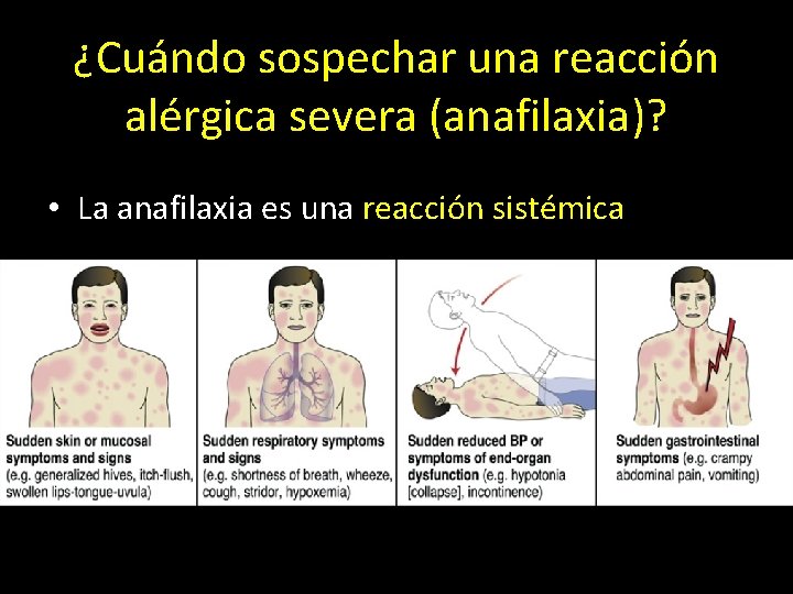 ¿Cuándo sospechar una reacción alérgica severa (anafilaxia)? • La anafilaxia es una reacción sistémica