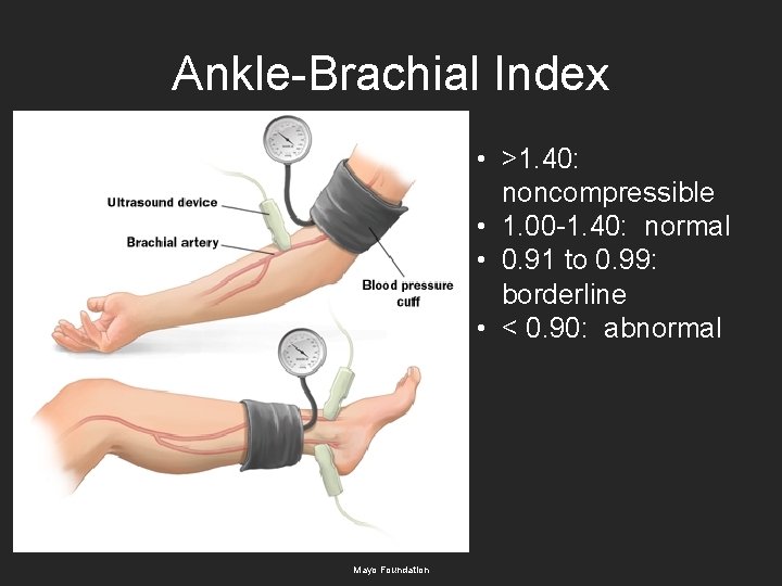 Ankle-Brachial Index • >1. 40: noncompressible • 1. 00 -1. 40: normal • 0. Ankle-Brachial Index • >1. 40: noncompressible • 1. 00 -1. 40: normal • 0.