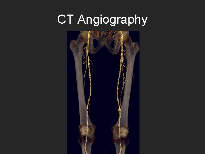 CT Angiography 