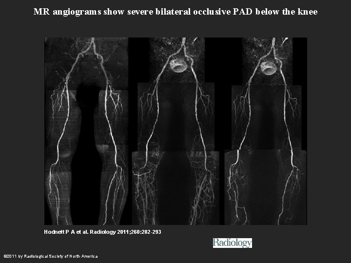 MR angiograms show severe bilateral occlusive PAD below the knee Hodnett P A et