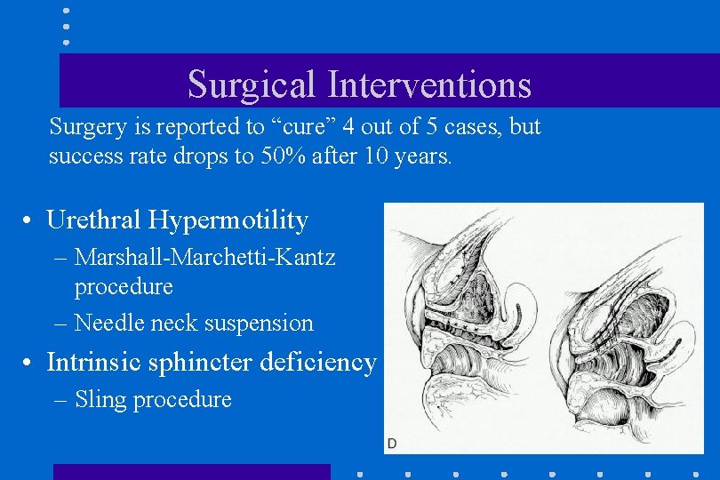 Surgical Interventions Surgery is reported to “cure” 4 out of 5 cases, but success