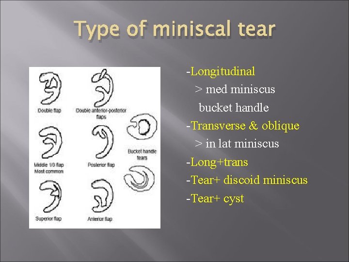 Type of miniscal tear -Longitudinal > med miniscus bucket handle -Transverse & oblique >
