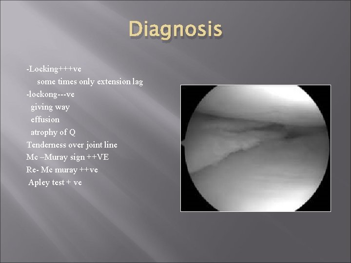 Diagnosis -Locking+++ve some times only extension lag -lockong---ve giving way effusion atrophy of Q