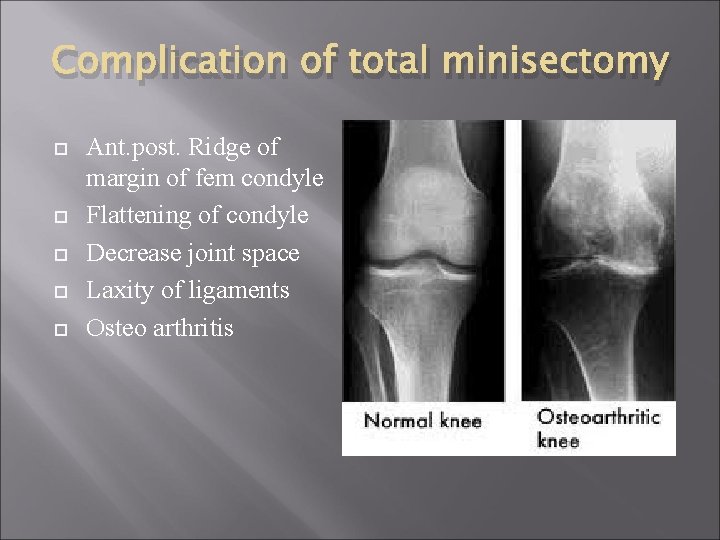 Complication of total minisectomy Ant. post. Ridge of margin of fem condyle Flattening of