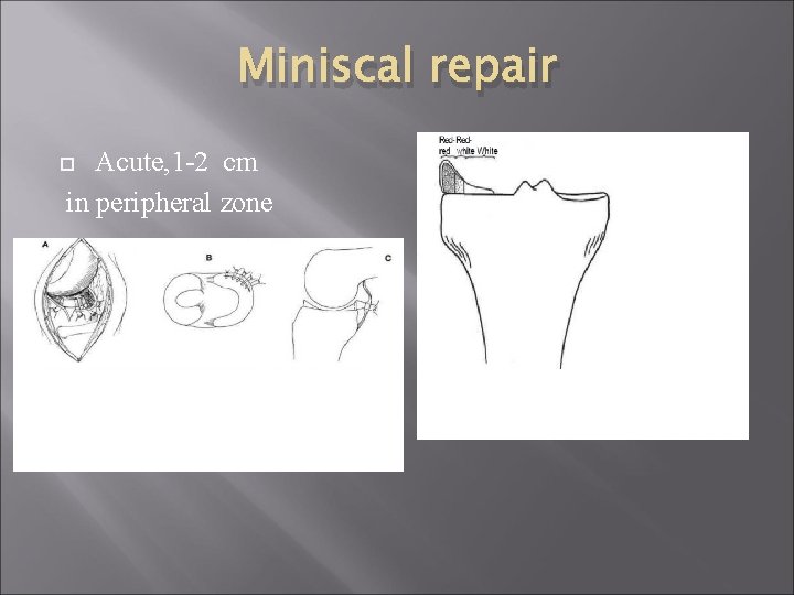 Miniscal repair Acute, 1 -2 cm in peripheral zone 