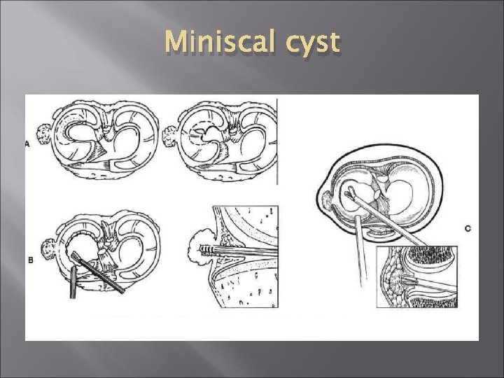 Miniscal cyst 