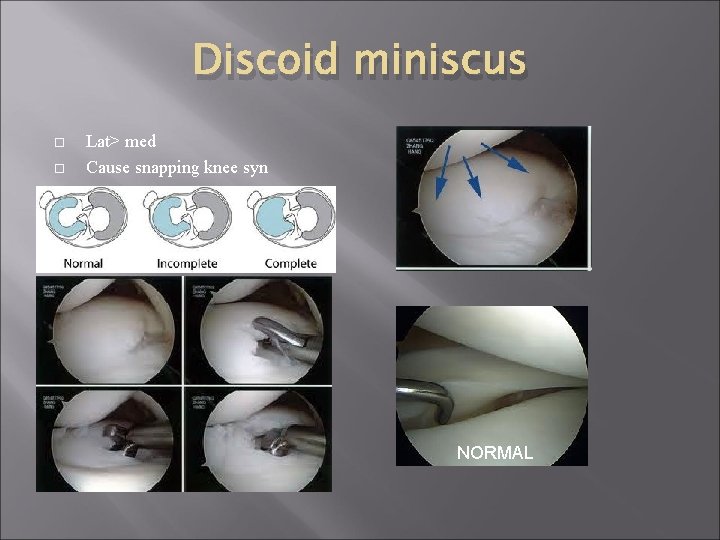 Discoid miniscus Lat> med Cause snapping knee syn NORMAL 