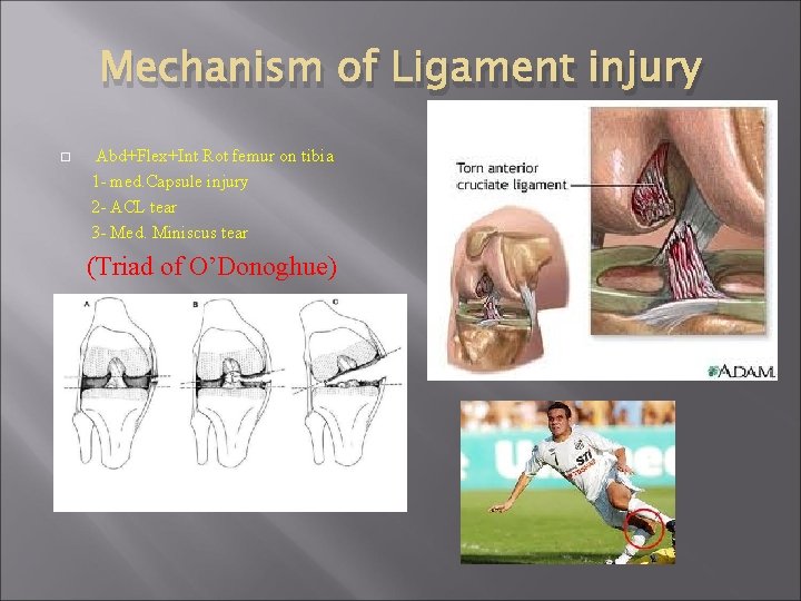 Mechanism of Ligament injury Abd+Flex+Int Rot femur on tibia 1 - med. Capsule injury