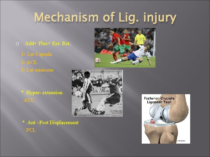 Mechanism of Lig. injury Add+ Flex+ Ext. Rot. 1 - Lat Capsule 2 -