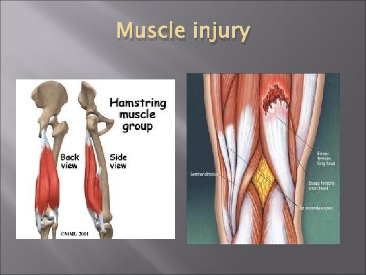 Muscle injury 
