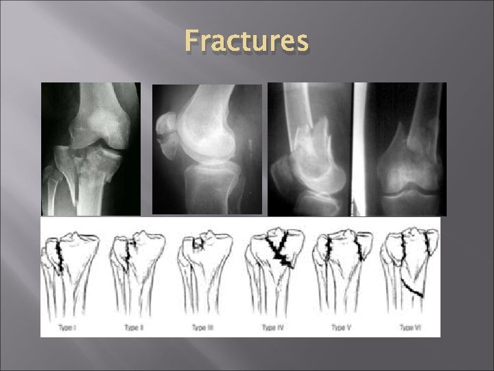 Fractures 