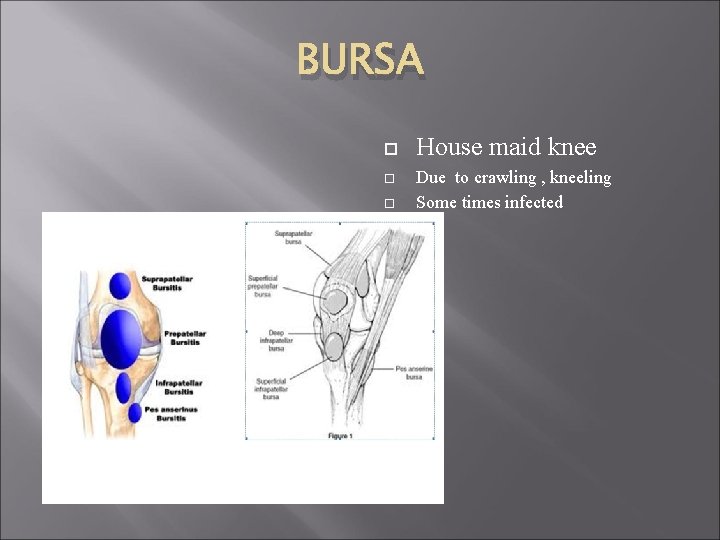 BURSA House maid knee Due to crawling , kneeling Some times infected 