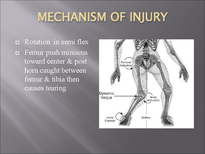 MECHANISM OF INJURY Rotation in semi flex Femur push miniscus toward center & post