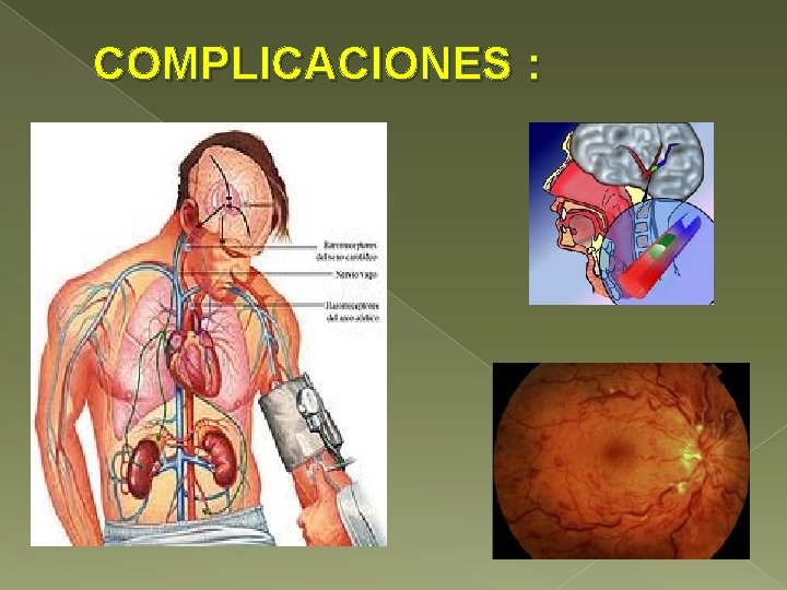 COMPLICACIONES : 