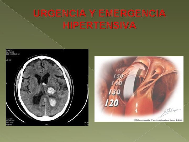 URGENCIA Y EMERGENCIA HIPERTENSIVA 