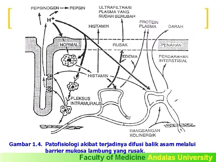 Gambar 1. 4. Patofisiologi akibat terjadinya difusi balik asam melalui barrier mukosa lambung yang