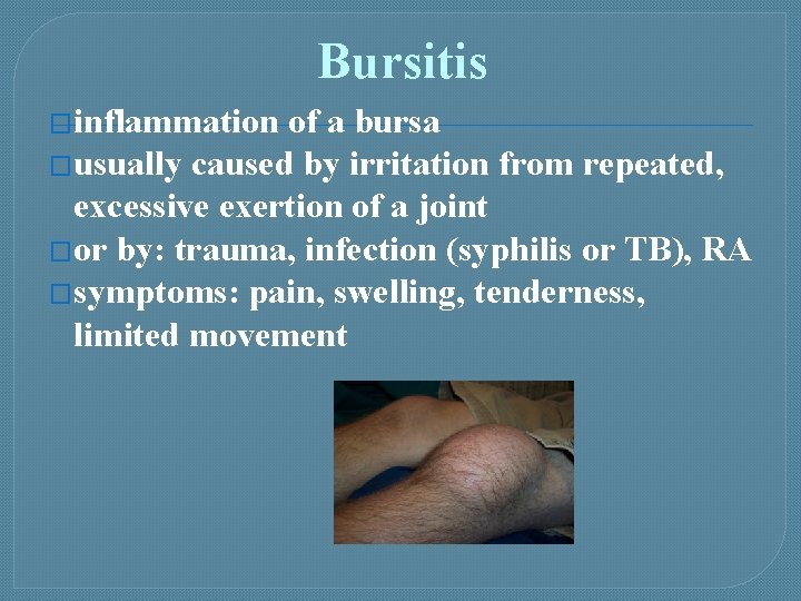 Bursitis �inflammation of a bursa �usually caused by irritation from repeated, excessive exertion of