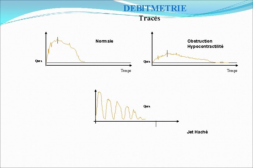 DEBITMETRIE Tracés Normale Obstruction Hypocontractilité Qura Temps Qura Jet Haché 